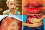 Allergy Symptoms 